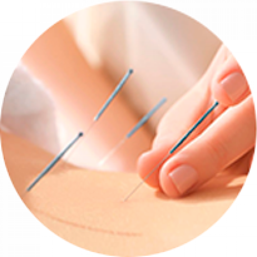Acupuntura